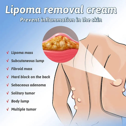 South Moon Lipoma Removal Cream ( buy 1 get 1 free )